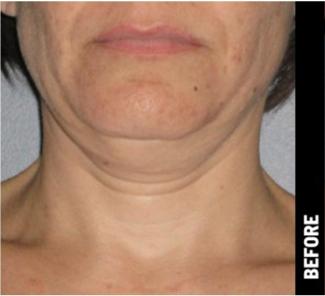 Ultherapy Before & After Patient #1554